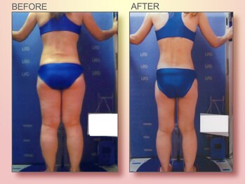 ジュリア オージェ 四条河原町店/ビフォーアフター（脂肪燃焼）