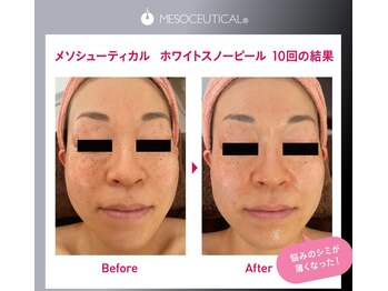 ボーソリューション(Beau-Solution)/【あらゆるシミケアへ】