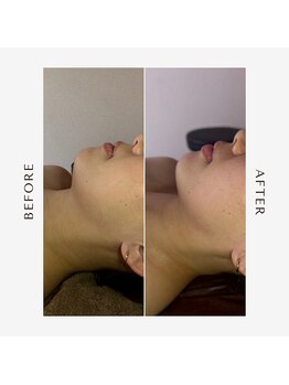 ルピナス 立川店/小顔矯正