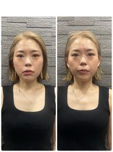 長寿鍼灸院 長寿整骨院/美容鍼50本の効果★小顔効果