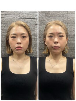 長寿鍼灸院 長寿整骨院/美容鍼50本の効果★小顔効果