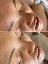 ファルファラ(farfara)/天然ハーブピーリング