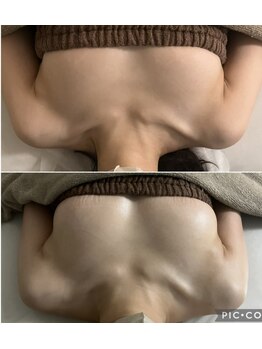 キレイバスト(Kireiii Bust)/ビフォーアフター