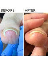 クオッカ(Quokka)/巻き爪ケア