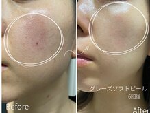 リュクスアンドコー 上田店(Luxe&co.)の雰囲気（【ツヤ/毛穴引き締め/透明感/シミの緩和爆誕！】）