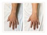 【営業職・接客業に大人気♪】腕丸ごと脱毛￥3,900（所要時間30分）/メンズ