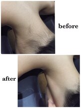 アンジュヴィバラヴィーダ(Ange viva la vida)/脱毛