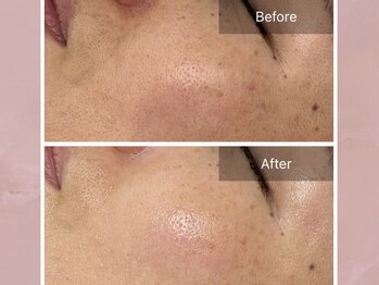 ステラルーテ(Stella lute)/エルモサハーブピーリング 1回