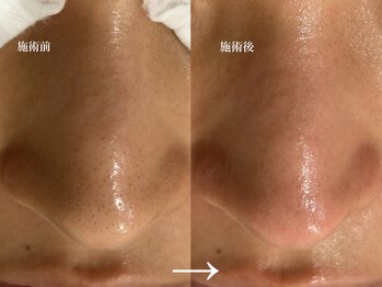 ウル 下北沢(Ulu)/韓国式3D毛穴毛穴洗浄