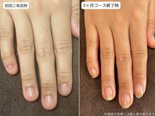 カピリナ(Ka Pilina)/自爪育成・深爪・川崎