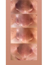ビューティーネイル(Beauty Nail)/毛穴も綺麗に吹き飛ばします。