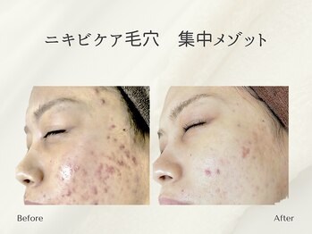 ホリスティックサロン ヘルバ(Holistic salon Herba)/跡ニキビ毛穴ケア 施術変化