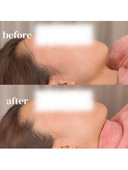 アルバ スキンガーデン(ALBAスキンガーデン)/before・after〈20代〉