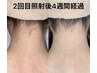 美肌脱毛でキレイな背中を手に入れる