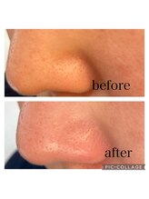 オゾンレメディ(O3remedy)/毛穴洗浄