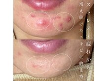 5回の施術☆大きく腫れ上がったニキビが跡にもならず改善へ♪