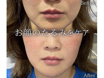 ビュウナ 銀座(BEAUNA)/マルチウェーブリフト