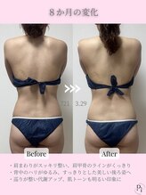 プラスワンビューティテン 新大阪店(Plus One Beauty)/ボディ/ハイパーナイフ/痩身