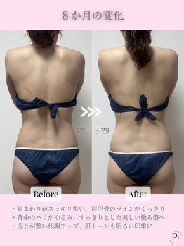 プラスワンビューティテン 新大阪店(Plus One Beauty)/ボディ/ハイパーナイフ/痩身