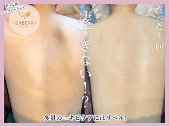 ハーバリー ハーブピーリング 大阪梅田店(HERBERRYハーブピーリング)/梅田ハーブピーリングHERBERRY