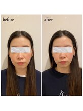 コス(KOS)/美容鍼45本+パック