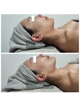 ビー アンド エイチ(B&H)/小顔＆リフトアップ（施術1回）