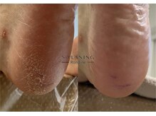 ロンディネ(Rondine)/韓国式足裏角質ケア