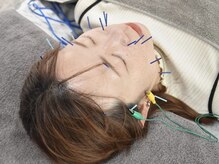 アキュリラ(Acurela)