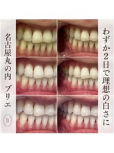 ブリエ(BRILLER)/高効果ホワイトニング　３日間