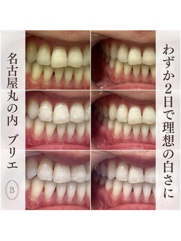 ブリエ(BRILLER)/高効果ホワイトニング　３日間