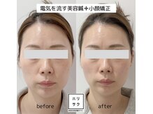 ハリサクの雰囲気（継続ケアで小顔に♪）