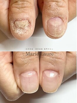 マリーロール 梅田店(Marie Laure)/自爪育成/深爪矯正/ネイルケア