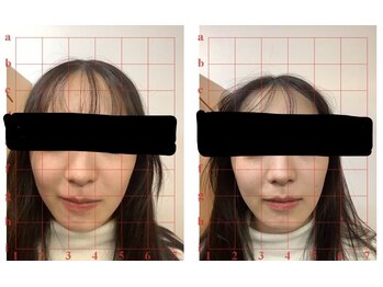 田端整体院/ほうれい線が消える小顔整体