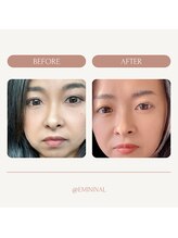 エミニナル(EMININAL)/【フェイシャル】変化