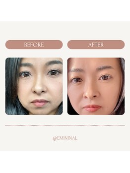 エミニナル(EMININAL)/【フェイシャル】変化