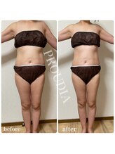 プラウディア(PROUDIA)/痩せる痩身エステ/ダイエット