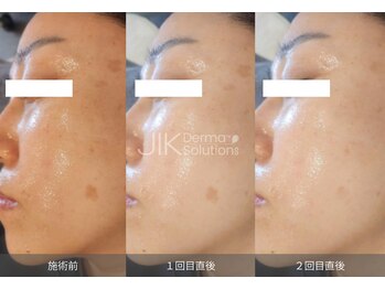 アティロン(Attirant)/ララピールの進化版ダクトピール