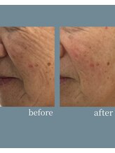 VENUS Esthetic Salon 麻布十番 【ヴィノス】/シワ改善