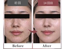 フルリール/【ニキビケアプロテクション】