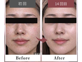 フルリール/【ニキビケアプロテクション】