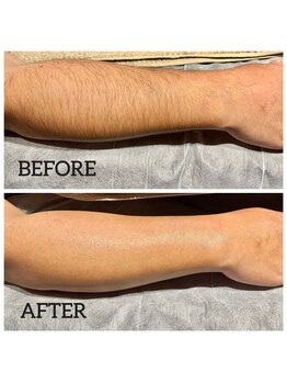 ココリ(CoCoRe)/腕wax脱毛