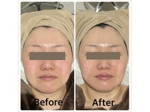 バブル(BUBRU)/光フェイシャル1回の変化