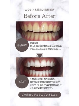 エクシアホワイト 平岸駅前店/ホワイトニング☆口コミのご紹介