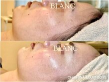 サロン ド ブラン アオヤマ(Salon de BLANC AOYAMA)の雰囲気(紫外線ケア*クリスティーナイラストリアス美白/ビフォーアフター)