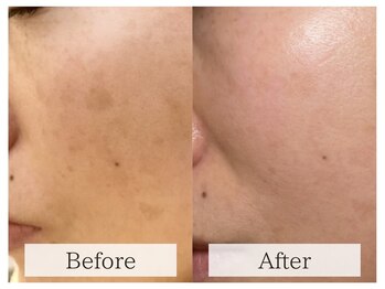 ルミラポー(Lumira Peau)/シミスポット