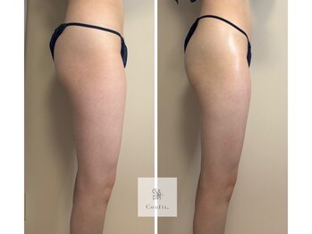 マシェリ 吉祥寺(Macherie)/脂肪燃焼 10ml導入