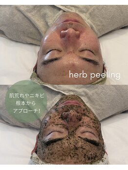 シキ(shiki)の写真/【メンズ肌改善◎】男性も素肌に自信を!清潔感UP!根本から整える結果重視のハーブピーリング。
