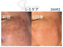 美シェリ(美Cheri)の雰囲気(諦めていた長年のシミにアプローチ!どんどん薄くなるシミに感動)