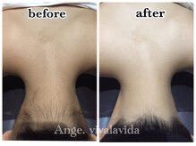 アンジュヴィバラヴィーダ(Ange viva la vida)/脱毛