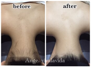 アンジュヴィバラヴィーダ(Ange viva la vida)/脱毛